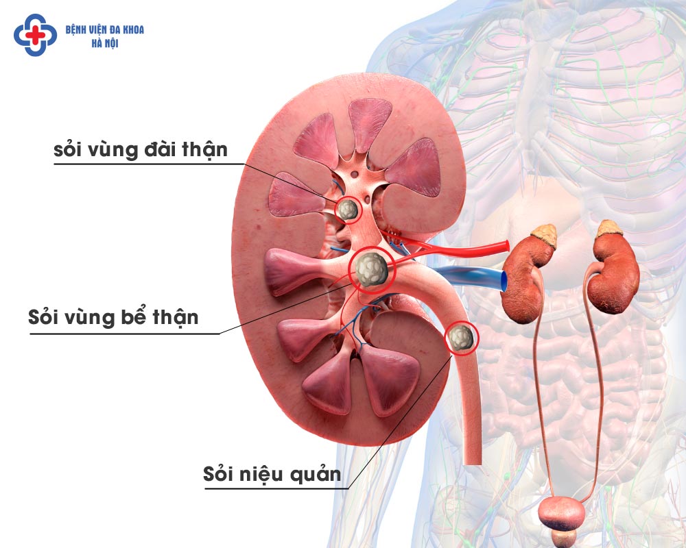 Sỏi trên niệu quản