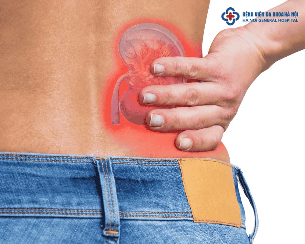phân biệt giữa đau sỏi thận và đau lưng