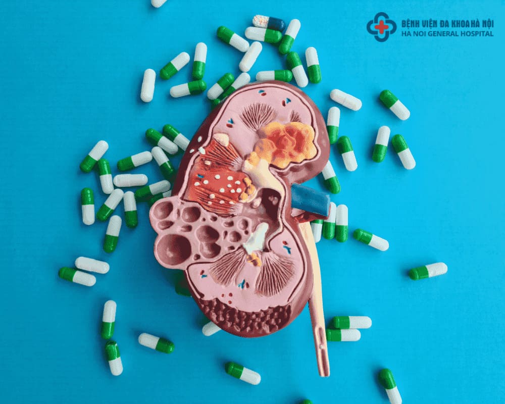 Điều trị sỏi thận tại nhà