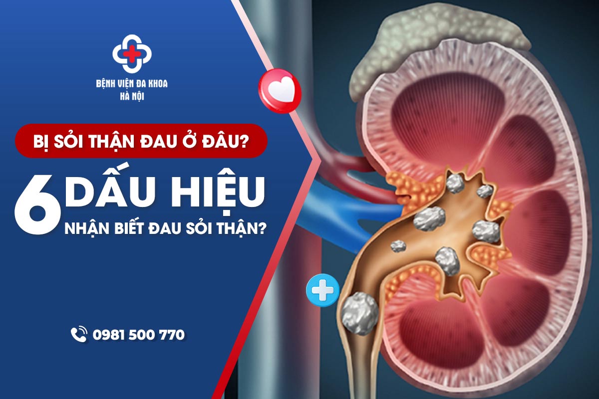 Bị sỏi thận đau ở đâu? 6 dấu hiệu nhận biết đau sỏi thận?
