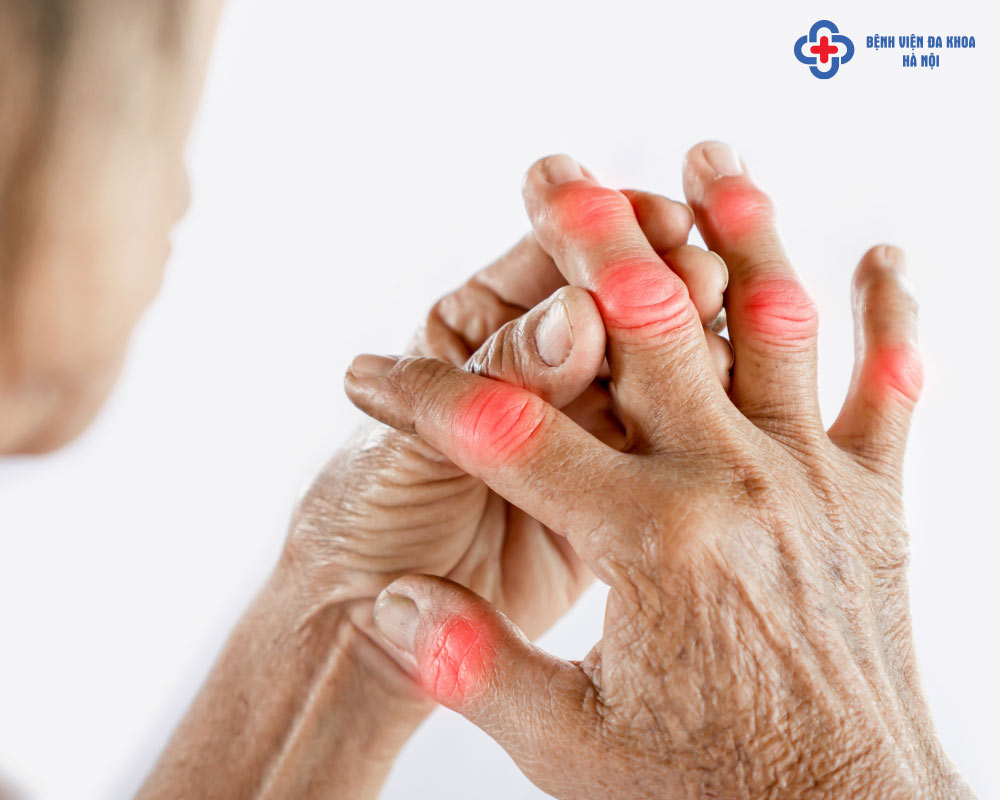Gout là bệnh tổn thương ở khớp, tất cả các khớp nhưng thường bị ở ngón tay ngón chân nhiều hơn