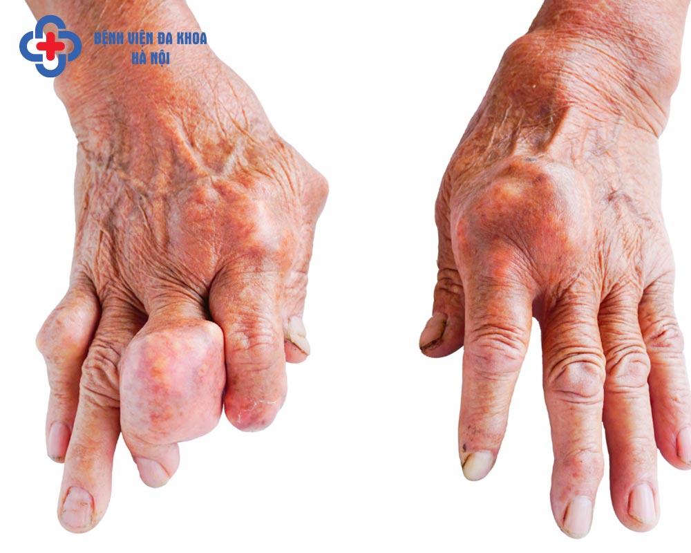 Biến chứng nguy hiểm của bệnh gout