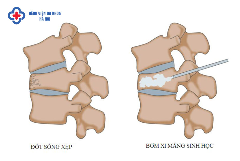 bơm xi măng