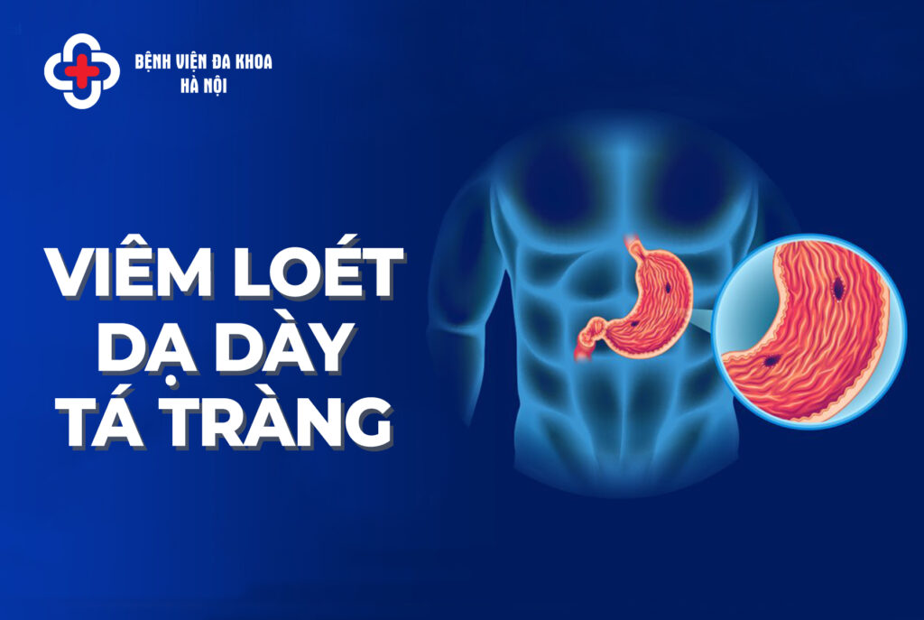 loét dạ dày tá tràng