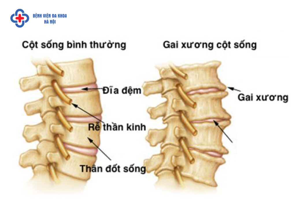 thoái hóa cột sống