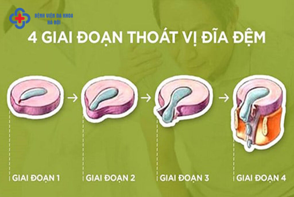 thoát vị đĩa đệm