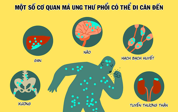 ung thư phổi di căn