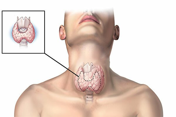 Phát hiện nguyên nhân bướu cổ