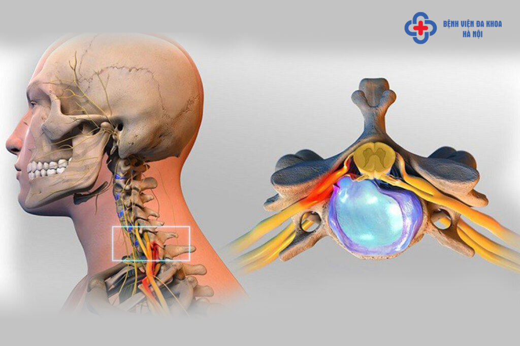 Thoát vị đĩa đệm đốt sống cổ lâu ngày gây ra biến chứng gì?