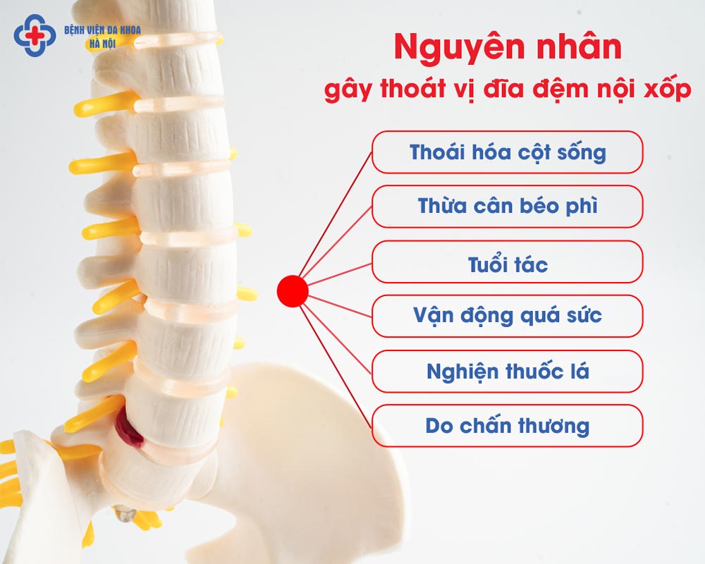 Nguyên nhân phổ biến gây thoát vị nội xốp đĩa đệm