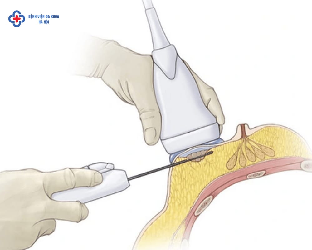 Kỹ thuật hút u vú chân không VABB được đánh giá là một phương pháp ít xâm lấn, hạn chế tối đa sẹo.