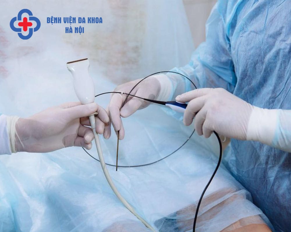 Đốt sóng cao tần RFA trong điều trị suy giãn tĩnh mạch