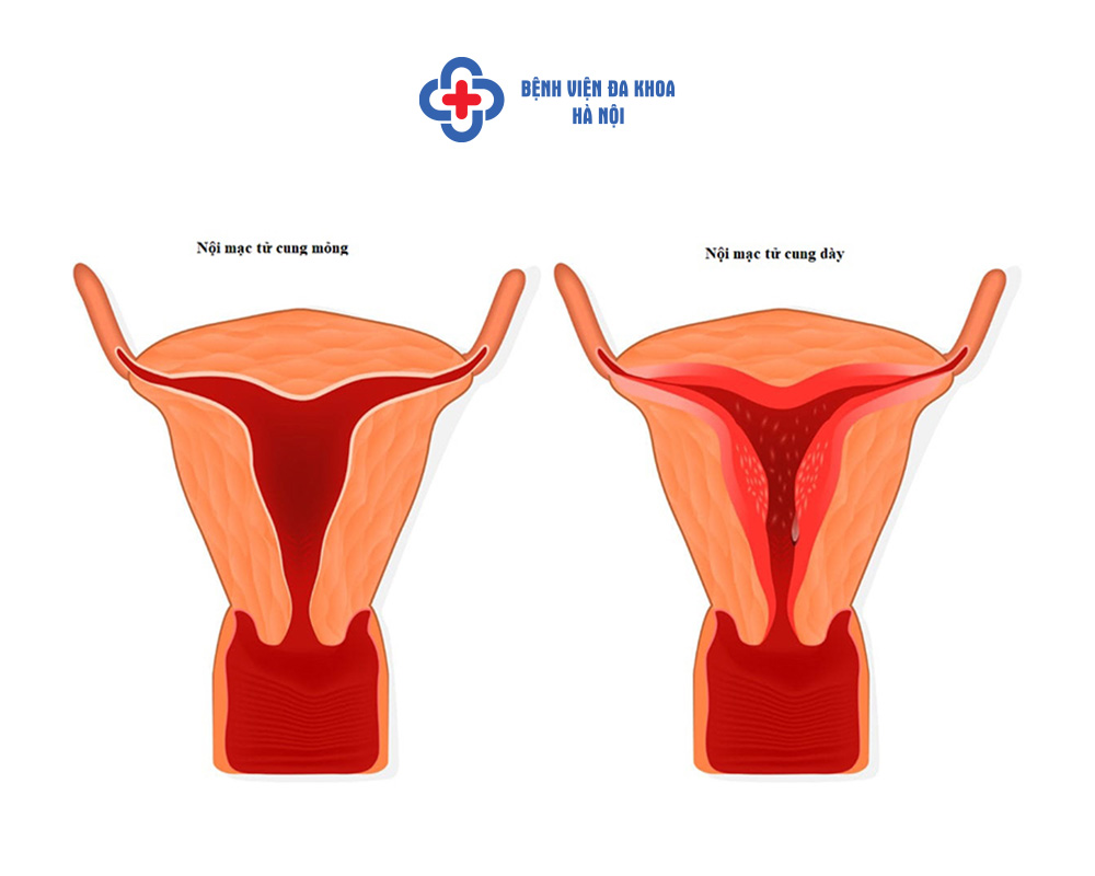 Theo dõi niêm mạc là bước vô cùng quan trọng trước chuyển phôi