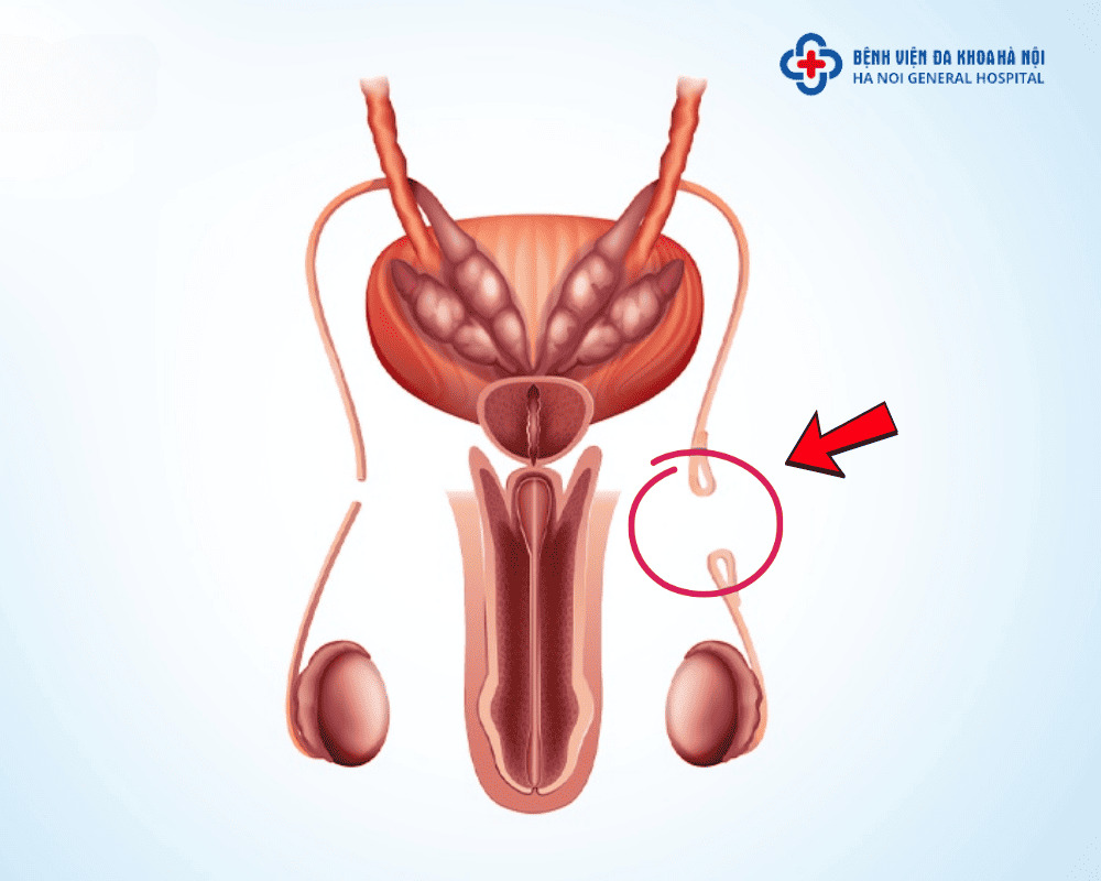 Thủ thuật thắt ống dẫn tinh