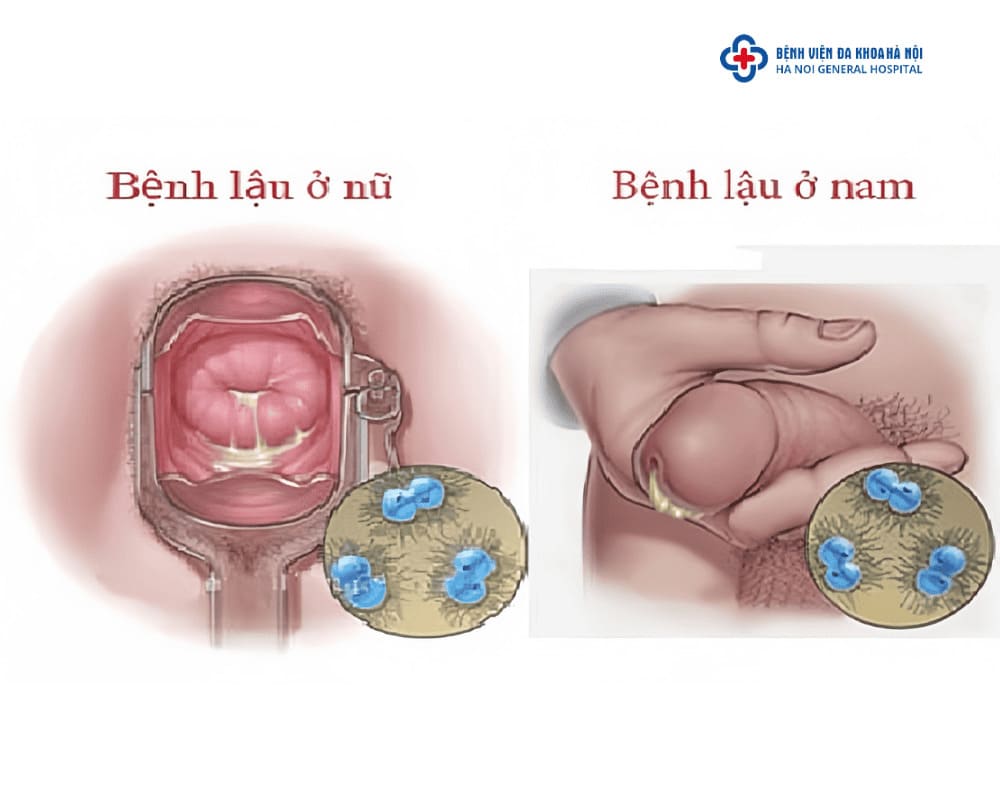 Triệu chứng của bệnh lậu, Chlamydia ở nam giới và nữ giới