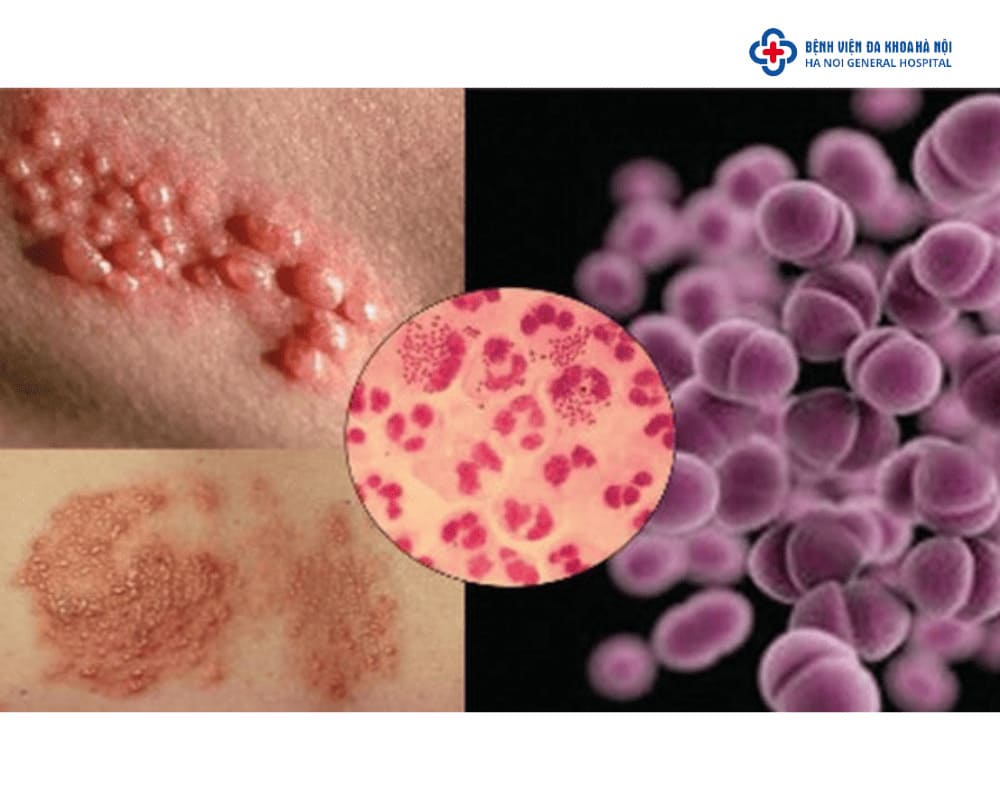 Điều trị bệnh lậu, chlamydia