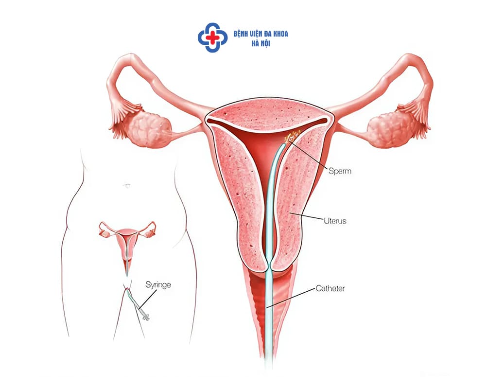 IUI được đánh giá là phương pháp hỗ trợ sinh sản chi phí khá tiết kiệm