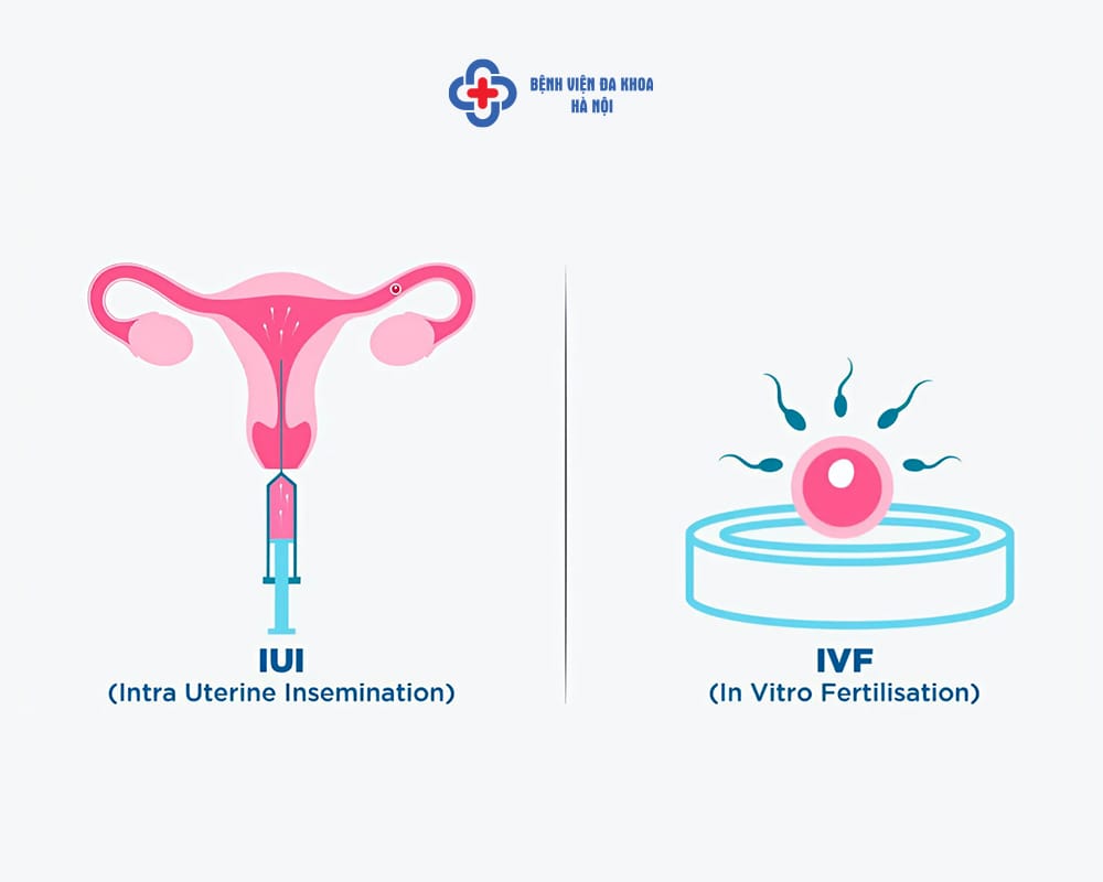 Có 2 phương pháp phổ biến nhất hiện nay là IUI Và IVF