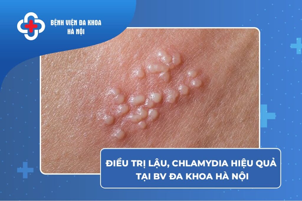 Điều Trị Lậu, Chlamydia Hiệu Quả Tại BV Đa Khoa Hà Nội