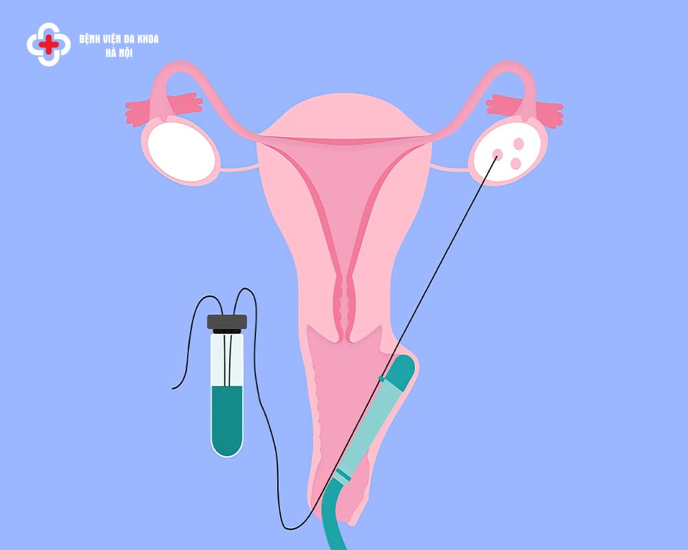 Chọc hút trứng là bước không thể thiếu trong chu trình IVF