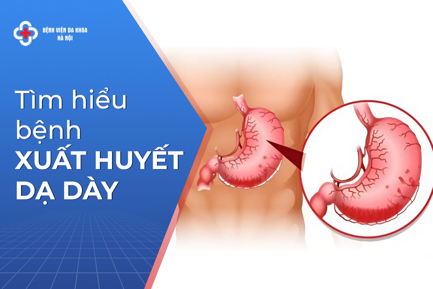 xuất huyết dạ dày