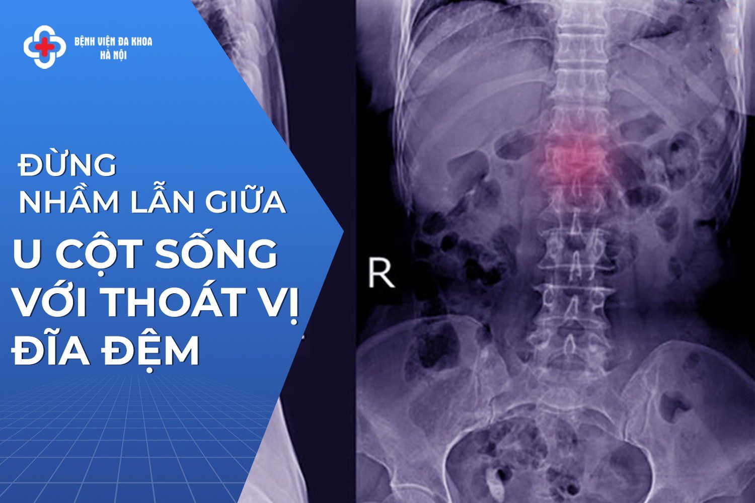thoát vị đĩa đệm