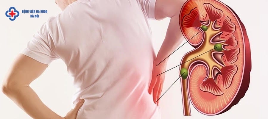 Một nửa số người mắc bệnh thận thường không có triệu chứng Một nửa số người mắc bệnh thận thường không có triệu chứng