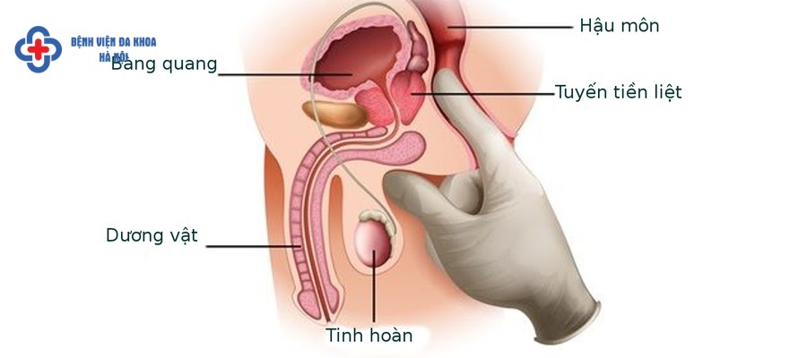Tìm hiểu những biến chứng sỏi bàng quang Tìm hiểu những biến chứng sỏi bàng quang