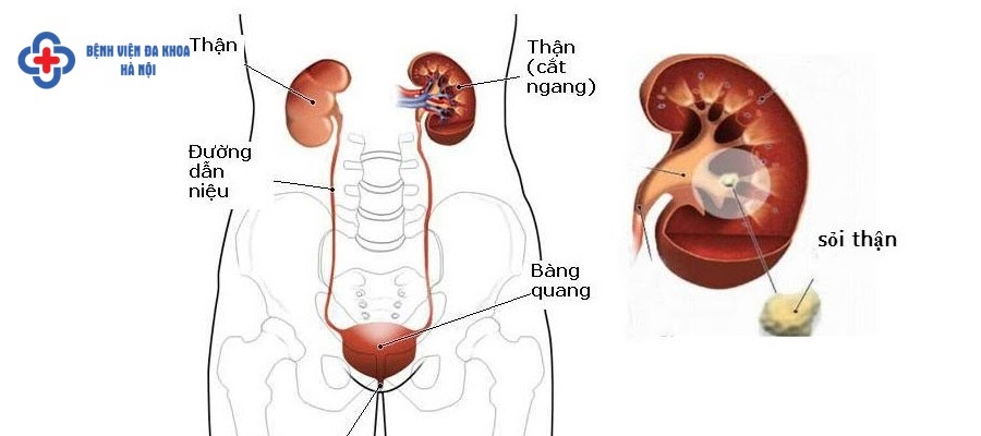 Dấu hiệu phát hiện sỏi thận sớm Dấu hiệu phát hiện sỏi thận sớm