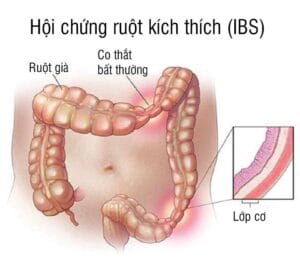 Hội chứng ruột kích thích gây trở ngại trong sinh hoạt người bệnh