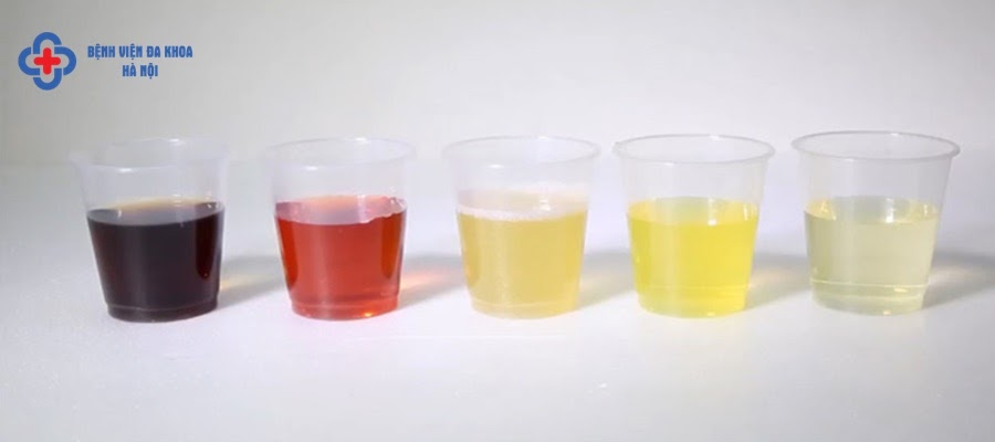 Nước tiểu người bệnh sỏi bàng quang sẽ đổi màu Nước tiểu người bệnh sỏi bàng quang sẽ đổi màu