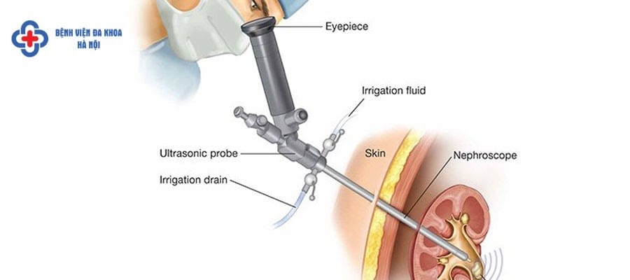 Tán sỏi qua da đường hầm nhỏ là gì? Tán sỏi qua da đường hầm nhỏ là gì?