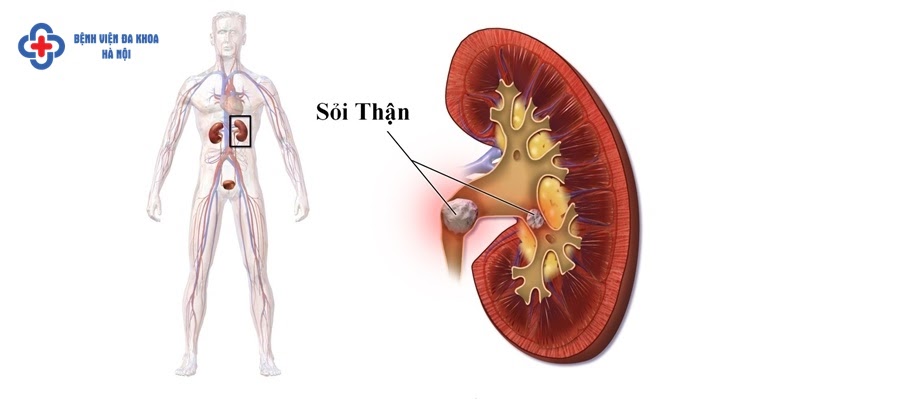 Siêu âm sỏi thận ở đâu tốt nhất Hà Nội? Siêu âm sỏi thận ở đâu tốt nhất Hà Nội?