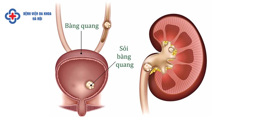 Sỏi bàng quang có nguy hiểm không? Sỏi bàng quang có nguy hiểm không?