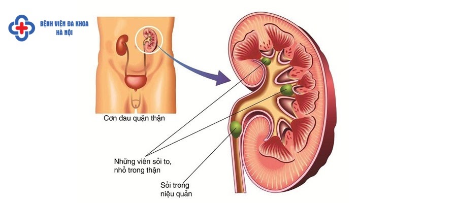 Phương pháp điều trị sỏi niệu quản hiệu quả là tán sỏi Phương pháp điều trị sỏi niệu quản hiệu quả là tán sỏi