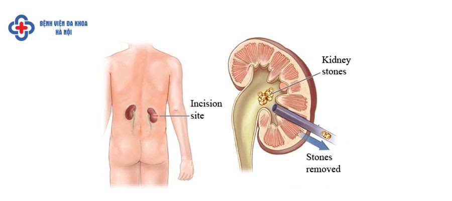 Sỏi thận nên mổ hay tán? Sỏi thận nên mổ hay tán?
