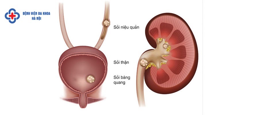 Sỏi thận nên mổ hay tán an toàn và hiệu quả hơn? Sỏi thận nên mổ hay tán an toàn và hiệu quả hơn?