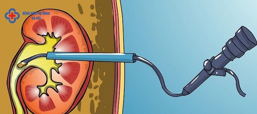 Tán sỏi có ảnh hưởng gì không? Tán sỏi có ảnh hưởng gì không?