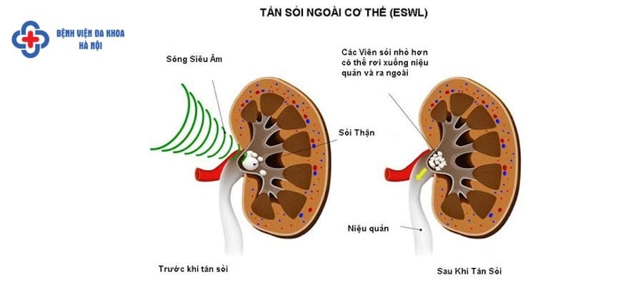 Ưu nhược điểm của phương pháp tán sỏi ngoài cơ thể là gì? Ưu nhược điểm của phương pháp tán sỏi ngoài cơ thể là gì?