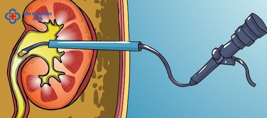 Trường nào được chỉ định tán sỏi? Trường nào được chỉ định tán sỏi?