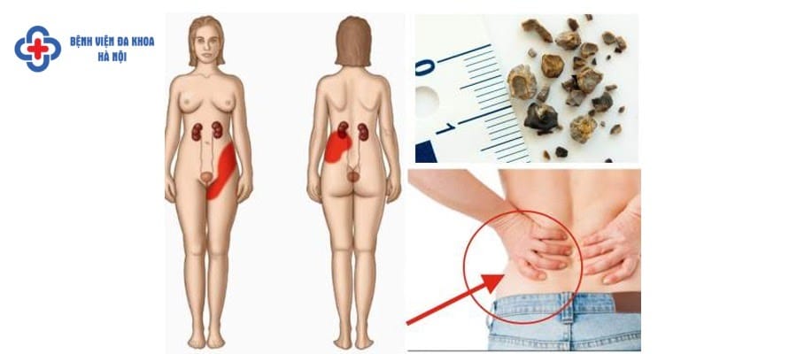 Triệu chứng sỏi thận ở phụ nữ Triệu chứng sỏi thận ở phụ nữ