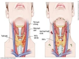 Phần lớn ca mắc ung thư vòm họng phát hiện khi bệnh ở giai đoạn muộn.