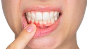 Viêm lợi khiến người bệnh mất tự tin trong cuộc sống hằng ngày.