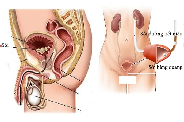Hình ảnh sỏi tại bàng quang 