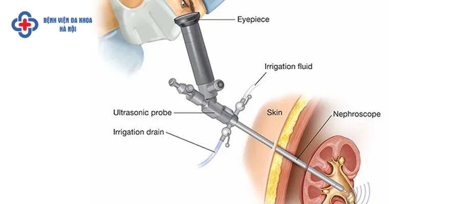 Phương pháp tán sỏi thận qua da là gì? Phương pháp tán sỏi thận qua da là gì?