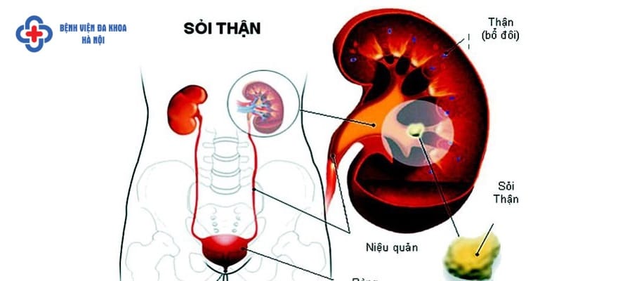 Chi phí tán sỏi thận qua da hết bao nhiêu tiền? Chi phí tán sỏi thận qua da hết bao nhiêu tiền?