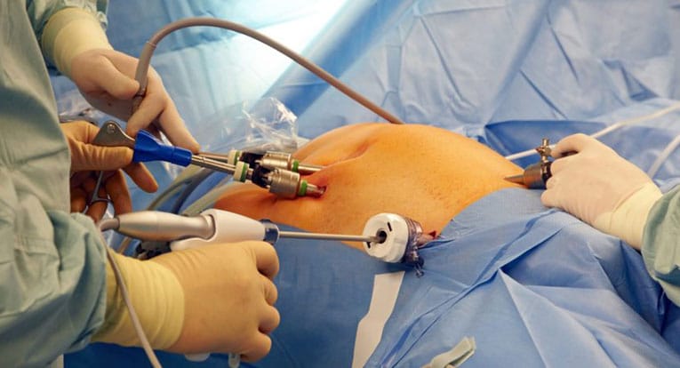 Một ca phẫu thuật tán sỏi nội soi điển hình