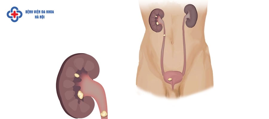 Sỏi thận là gì? Sỏi thận là gì?