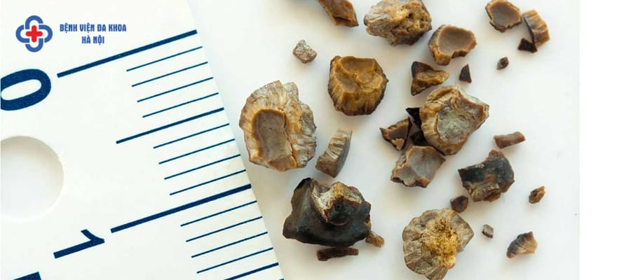 Sỏi thận 5mm có phải mổ không? Sỏi thận 5mm có phải mổ không?