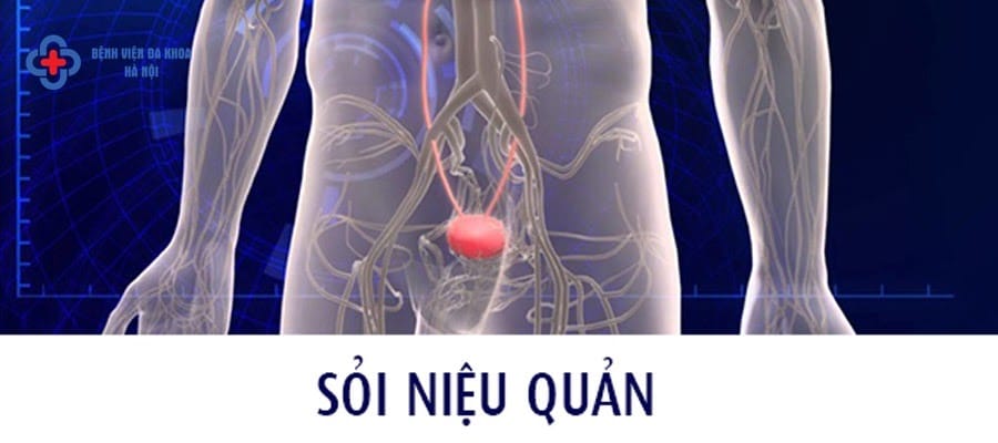 Tán sỏi niệu quản ở đâu an toàn? Tán sỏi niệu quản ở đâu an toàn?